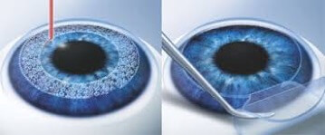 Επέμβαση Lasik Επεμβαση Lasik femtosecond laser