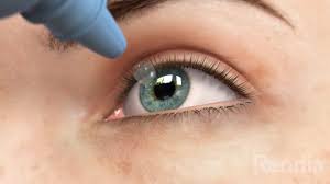 femto lasik μυωπια