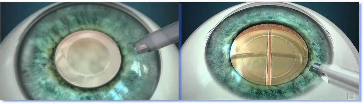 Операция катаракта замена хрусталика отзывы. Фемтосекундный лазер катаракта. Лазерная экстракция катаракты лазер. Катаракта факоэмульсификация.