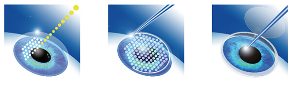 femtosecond laser lasik διορθωση μυωπιας