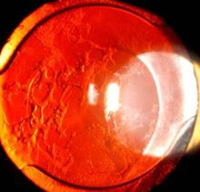 secondary cataract