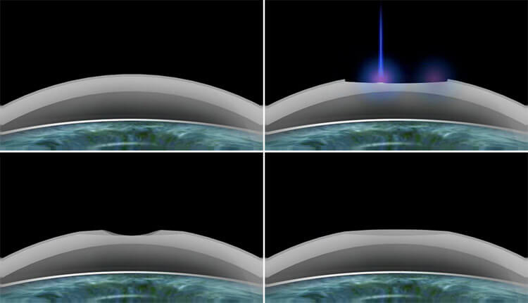 λειζερ trans PRK επεμβαση
