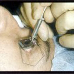 muwpia methodos lasik 5