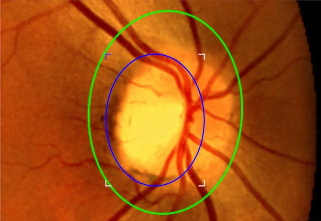 οπτικη θηλη γλαυκωμα